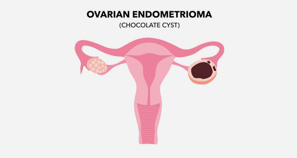 Endometrioma (Çikolata Kisti)