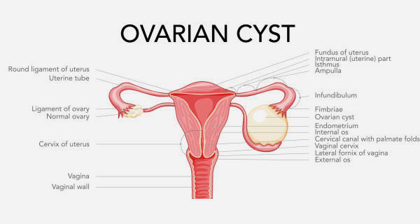 Yumurtalık Kistleri