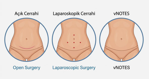vNOTES Cerrahi (İzsiz Cerrahi)