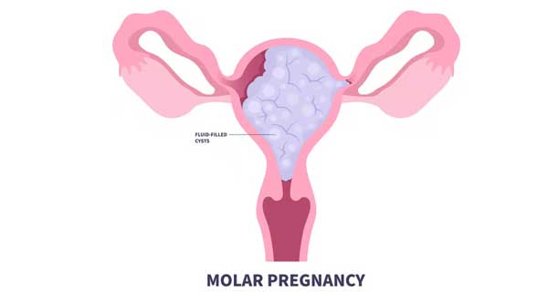 Histerektomi (Rahmin Alınması)