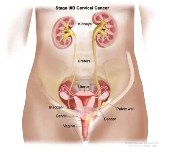 Evre 3B serviks kanserinde tümörün görünümü. Tümör pelvis yan duvarına ulaşır.
