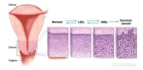 Normal servikal dokudan serviks kanserine dönüşüm aşamaları