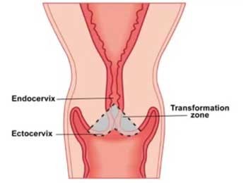 Konizasyonda çıkarılan ektoserviks ve endoservikal kanalın gösterilmesi
