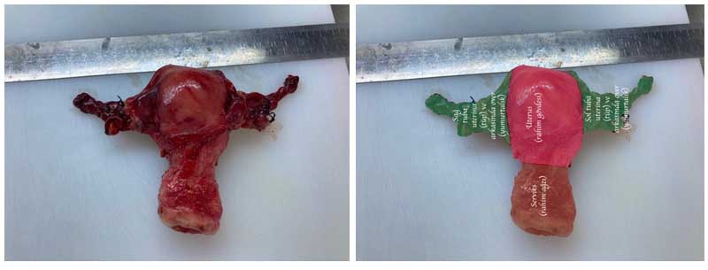 Rahim, tüpler ve yumurtalıkların önden görünümü.