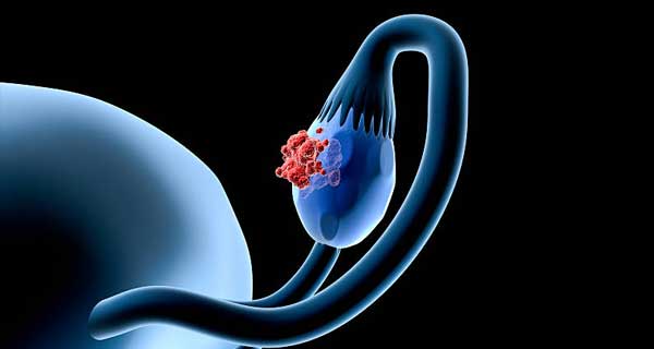 Yumurtalık (Over) Kanseri